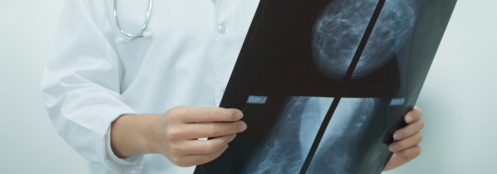 It-would-be-a-deadly-mistake-to-discourage-breast-cancer-screenings