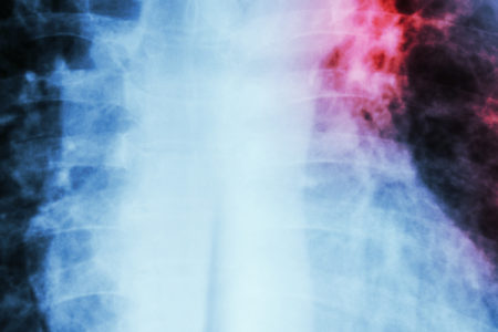 Image for Why tuberculosis is a public health concern